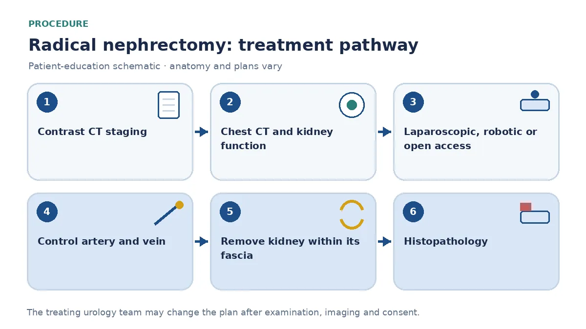 Step-by-step radical nephrectomy pathway infographic showing contrast CT staging, chest CT, kidney-function assessment, laparoscopic or open vessel control, removal of the kidney within its fascia and histopathology