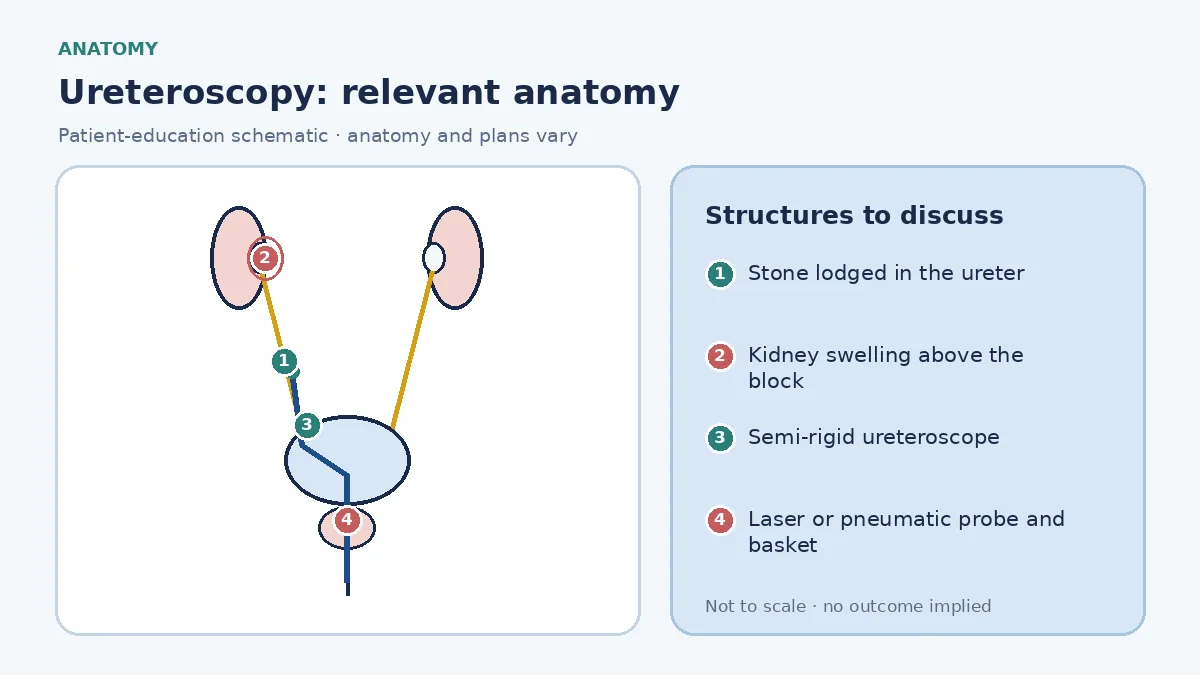 Medical infographic of ureteroscopy anatomy showing the urethra, bladder, both ureters and kidneys with a stone lodged in one ureter and a semi-rigid ureteroscope advanced up to it