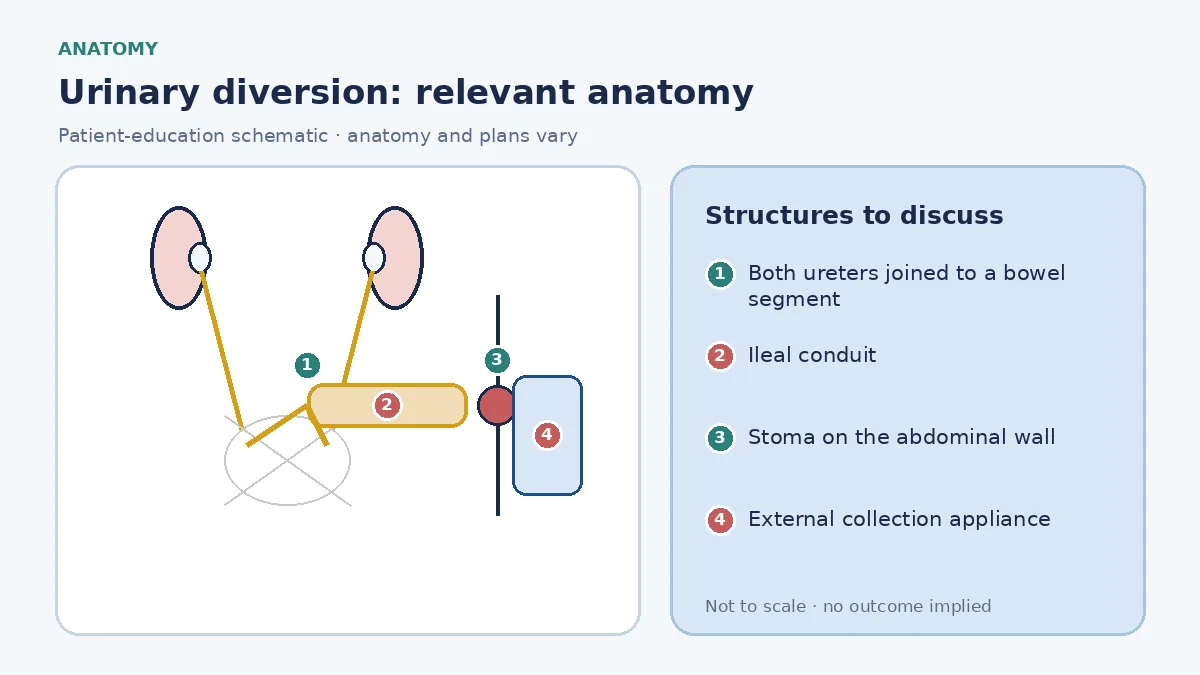 Medical infographic of urinary diversion anatomy showing both ureters joined to an isolated segment of small bowel that passes through the abdominal wall to a stoma with an external collection appliance