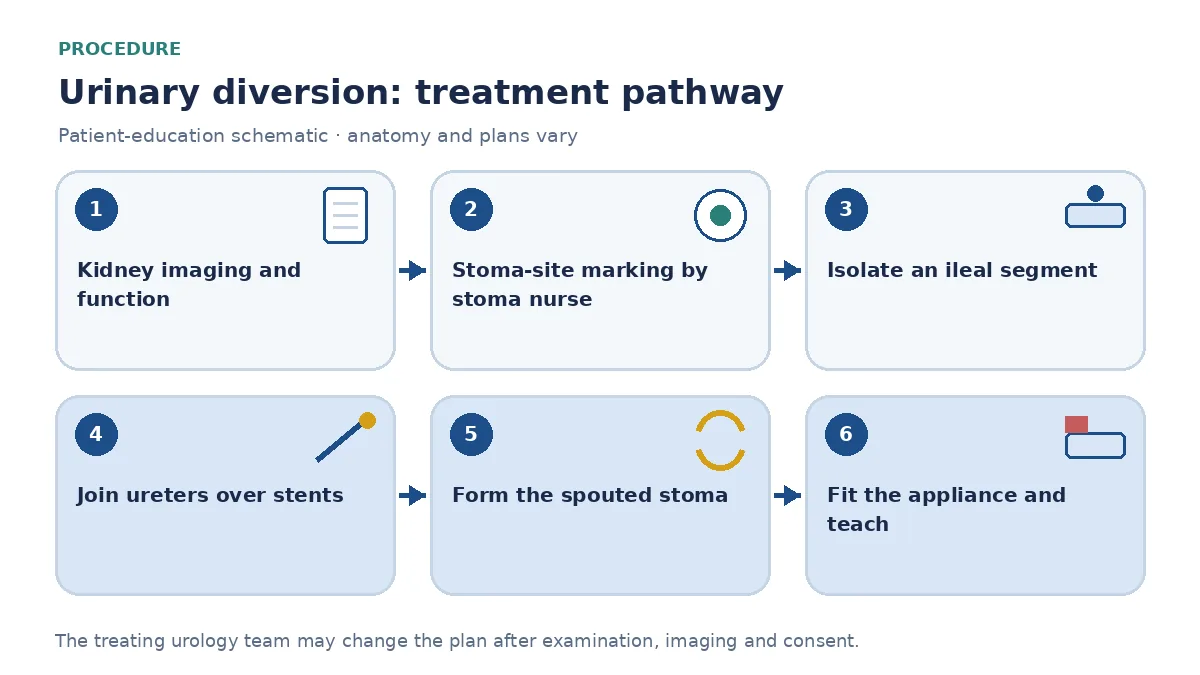 Step-by-step urinary diversion pathway infographic showing kidney imaging and stoma-site marking, isolating an ileal segment, joining the ureters over stents, forming the stoma, fitting the appliance and stoma-nurse teaching