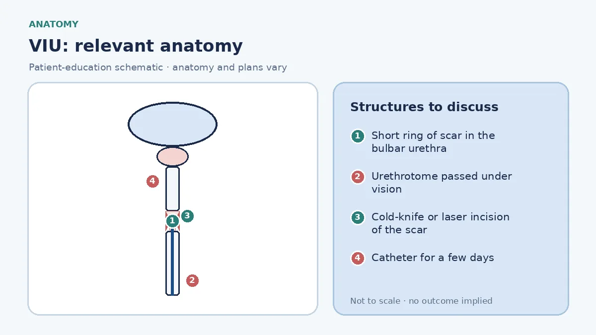 Medical infographic of VIU anatomy showing the male urethra with a short ring of scar tissue narrowing the bulbar segment and an endoscopic urethrotome blade positioned to incise the scar under vision