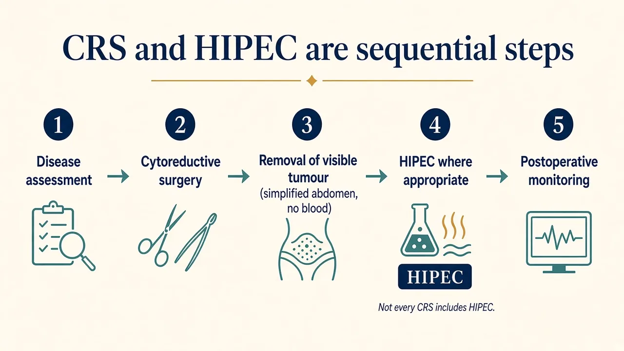 Illustration showing the main stages of cytoreductive surgery and HIPEC treatment