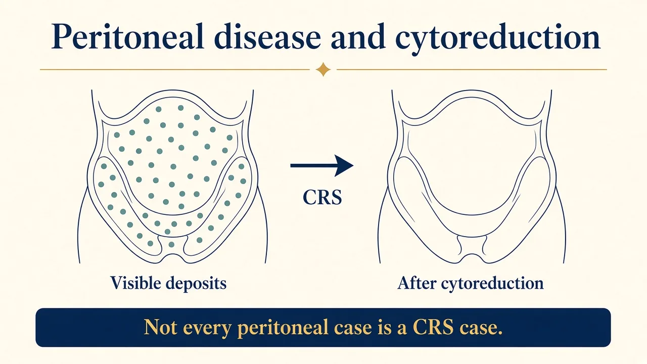 Medical illustration showing peritoneal tumour deposits and the concept of cytoreductive surgery