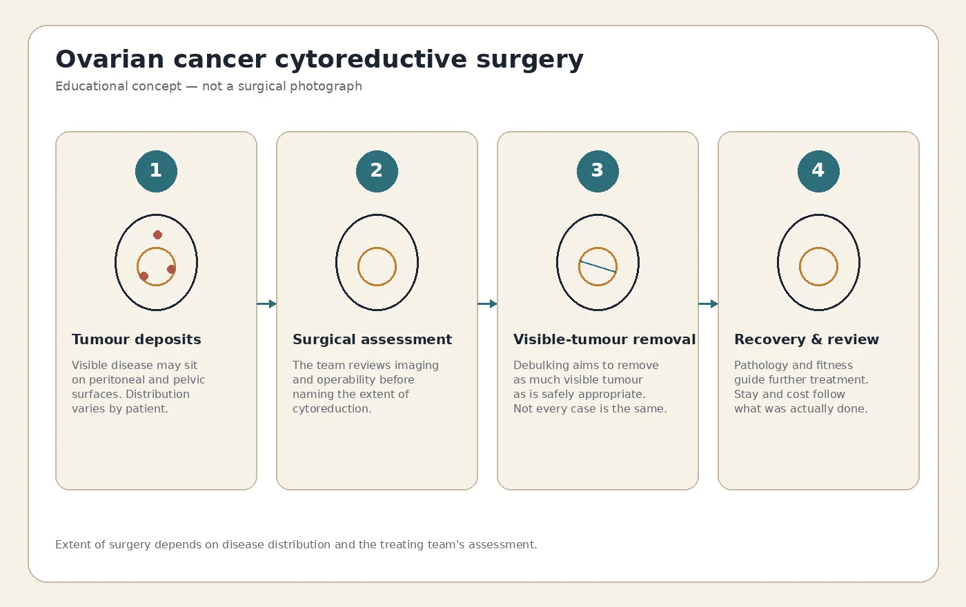 Medical illustration explaining ovarian cancer cytoreductive surgery and tumour debulking