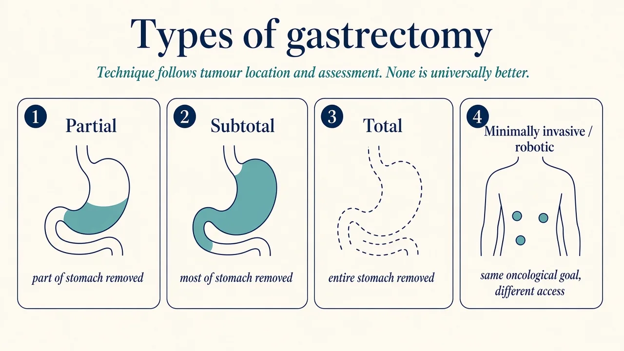 Illustration comparing partial, subtotal and total gastrectomy procedures