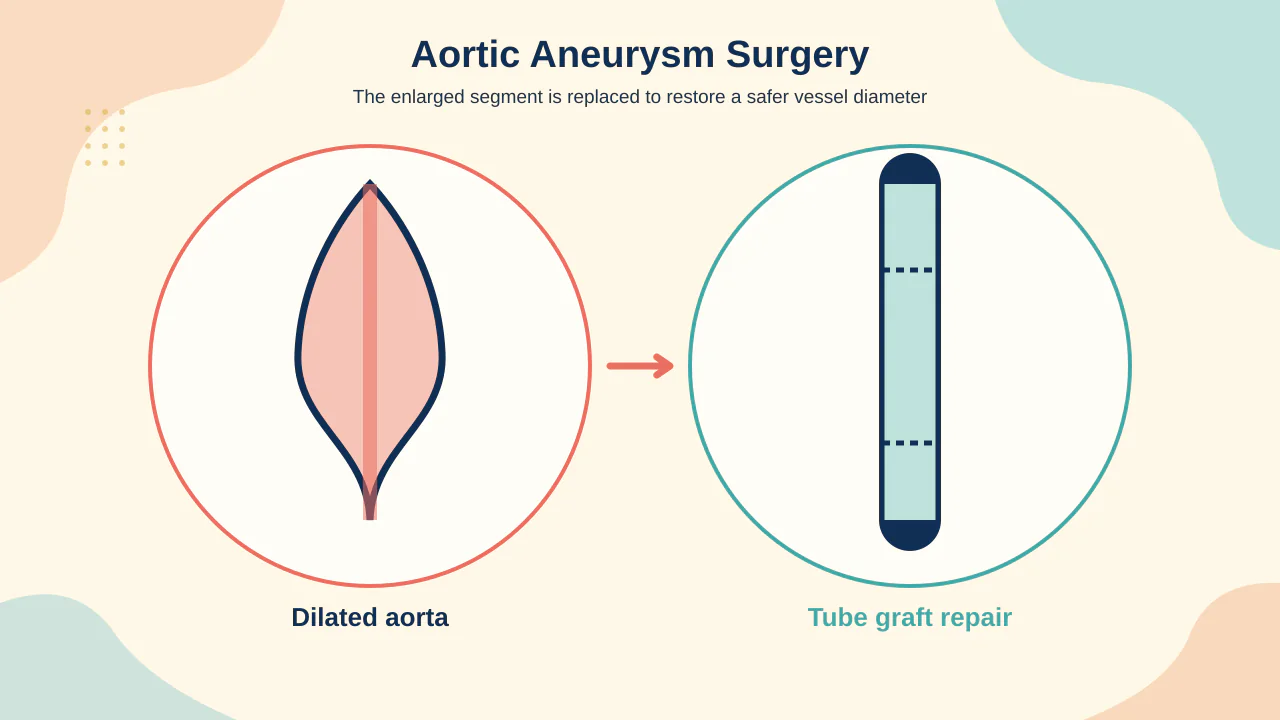 Medical illustration comparing open graft replacement and endovascular stent-graft exclusion of thoracic aortic aneurysm segments