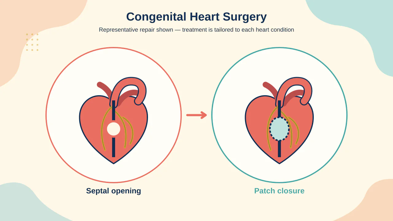 Medical illustration of individualized congenital heart pathways including septal repair, outflow reconstruction and staged circulation