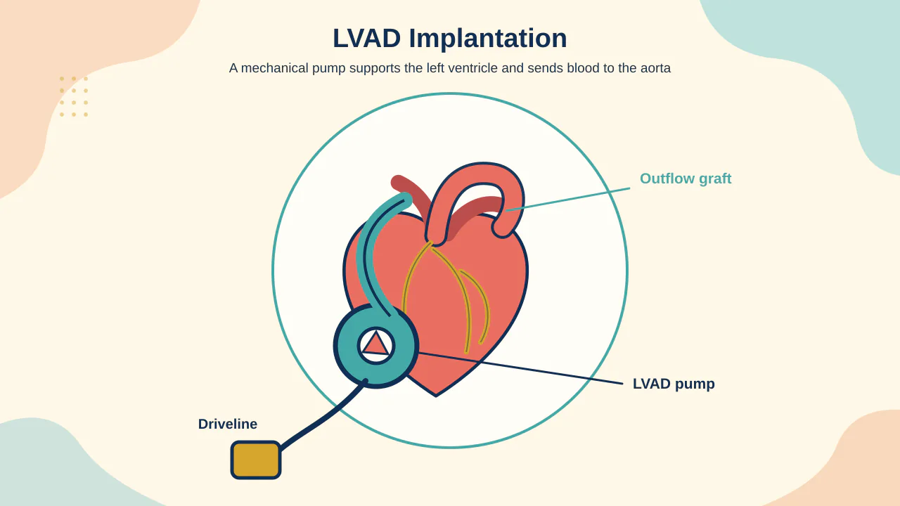 Medical illustration of a durable LVAD pump, ventricular inflow, aortic outflow graft, driveline, controller and external batteries