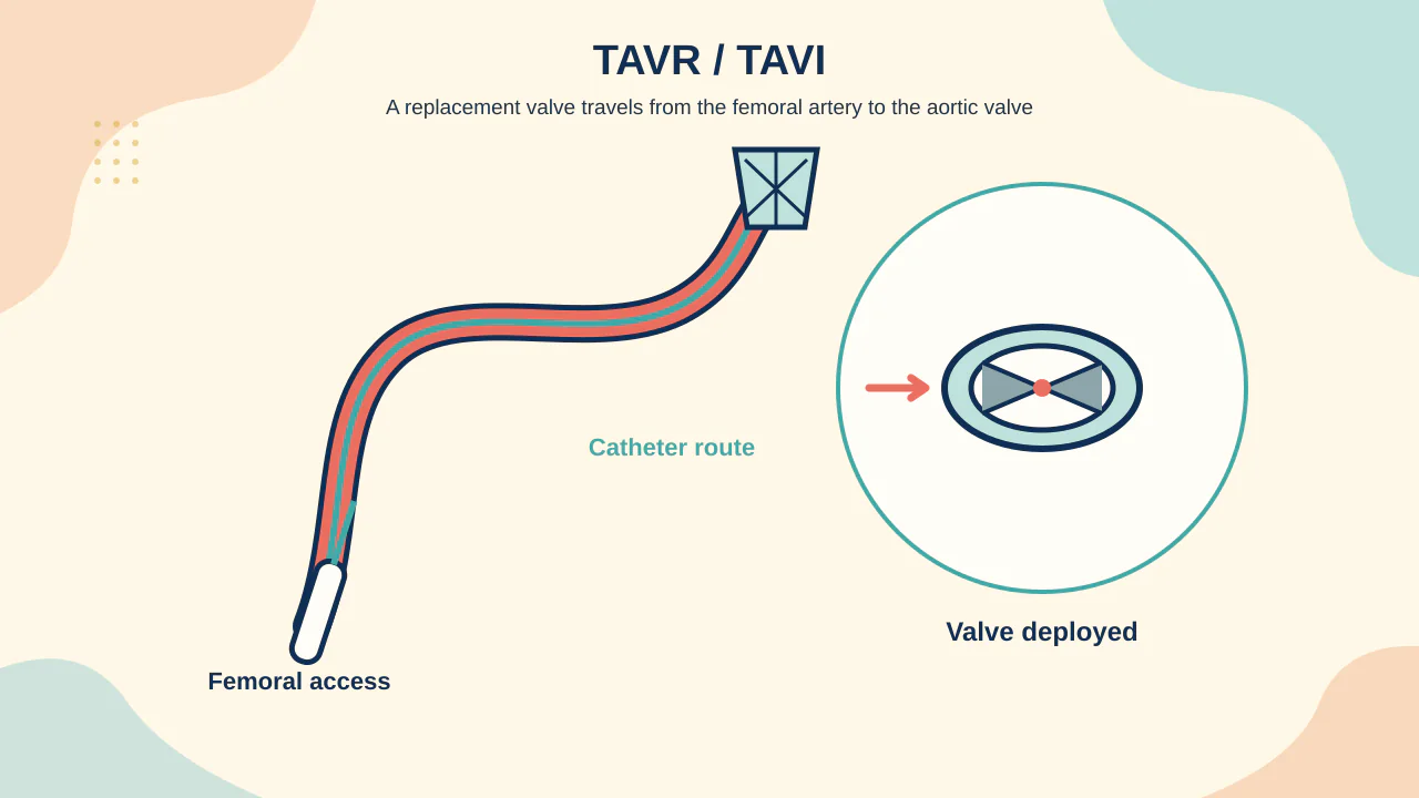 Medical illustration of a transcatheter tissue aortic valve advanced through femoral access and deployed inside a stenotic native valve