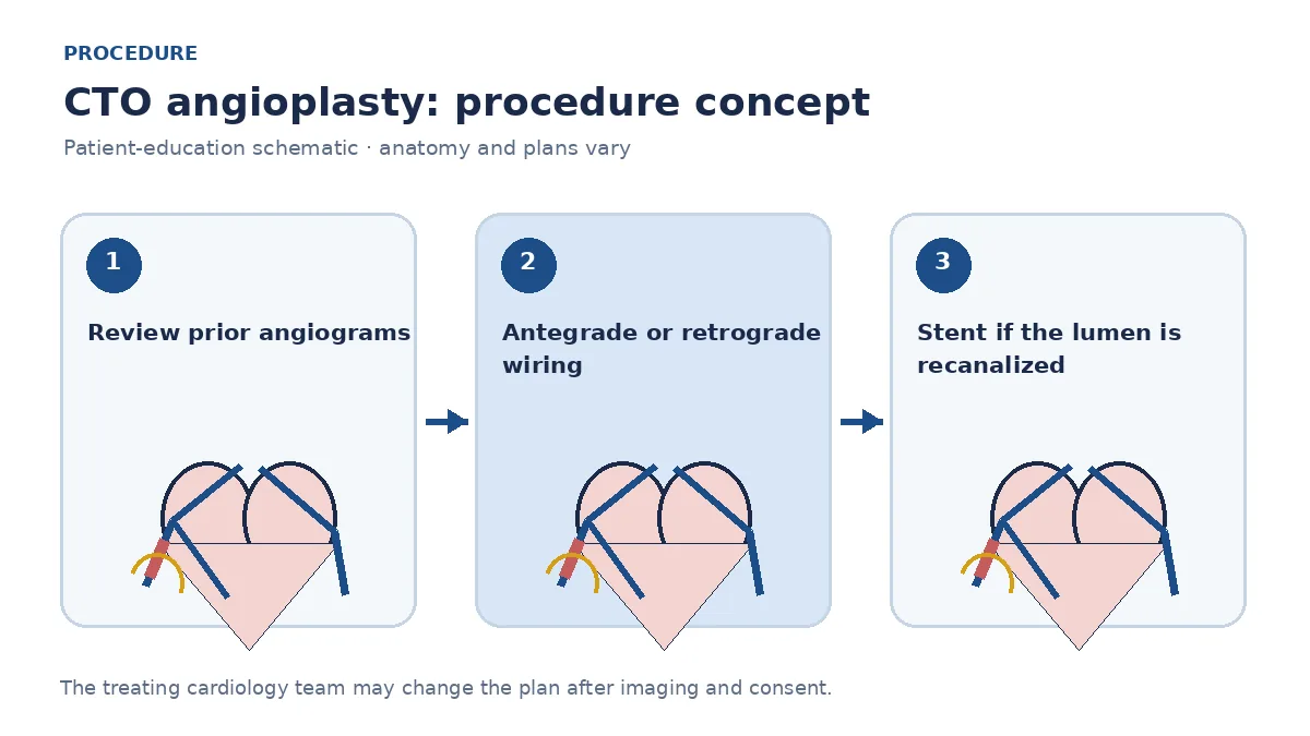 Clinical diagram of dual arterial access and specialized wires attempting to recanalize a chronic total occlusion