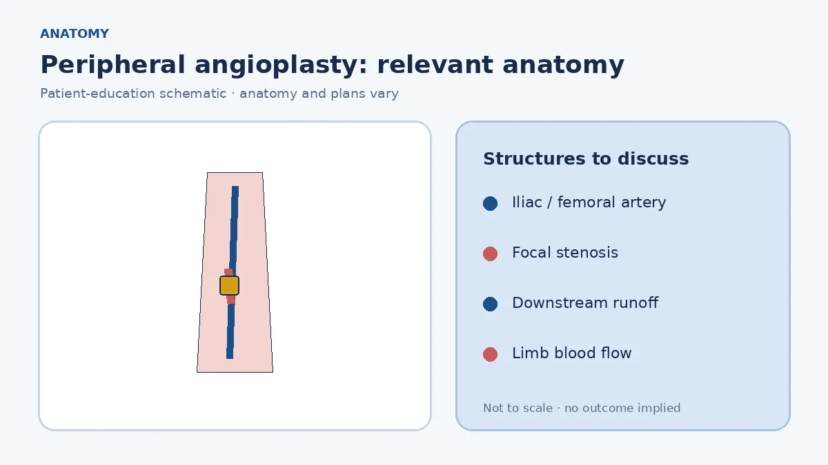 Medical illustration of a narrowed femoral or iliac artery reducing blood flow to the lower limb