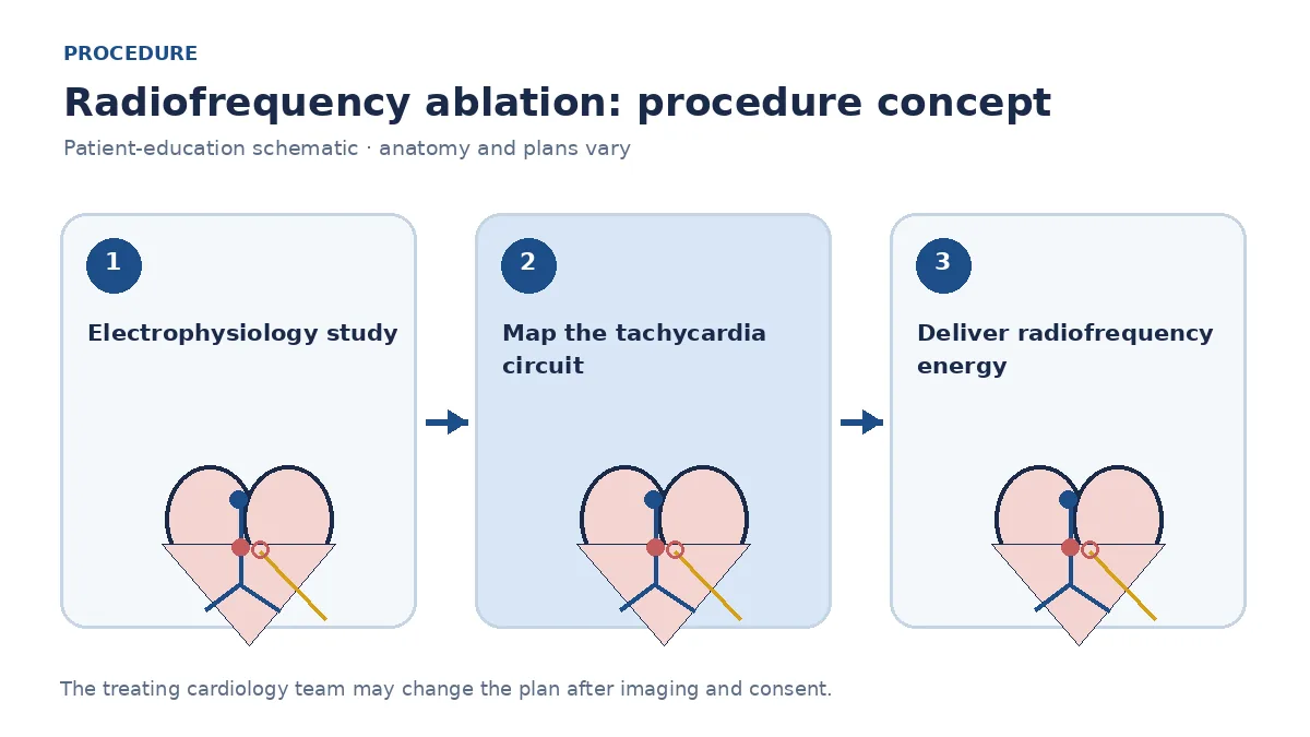 Clinical diagram of diagnostic and ablation catheters mapping a tachycardia circuit and delivering radiofrequency energy