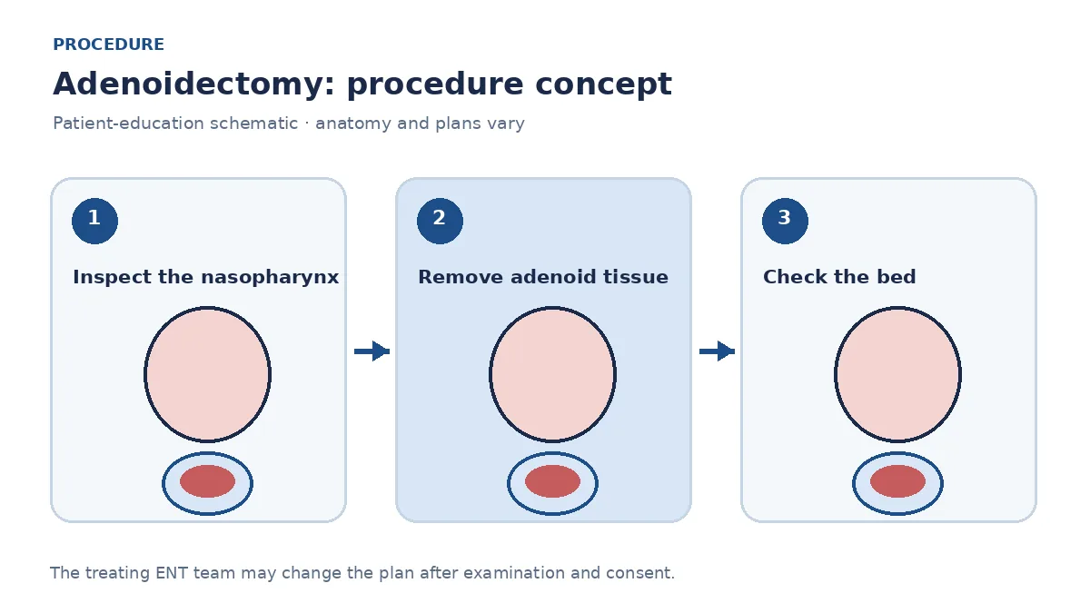 Clinical diagram of adenoid removal from the nasopharynx under oral view
