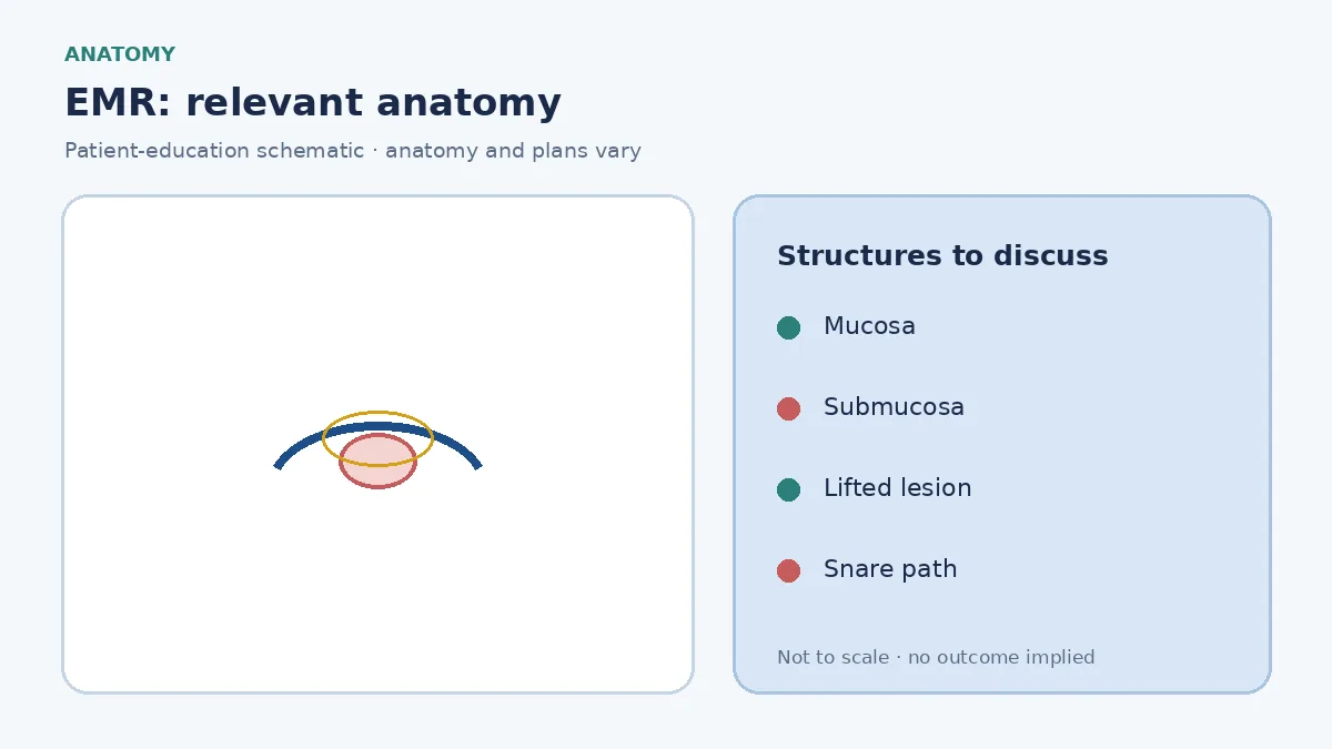 Medical illustration of a mucosal lesion sitting on the inner GI wall layers