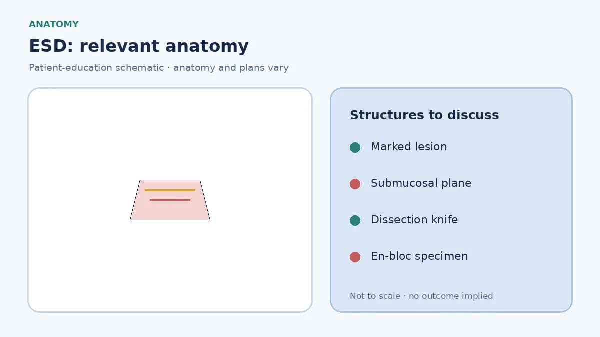 Medical illustration of GI wall layers showing a mucosal neoplasm planned for en-bloc ESD