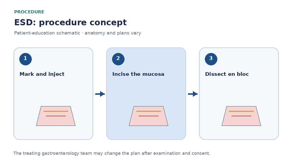 Clinical diagram of endoscopic knife dissection in the submucosa during ESD
