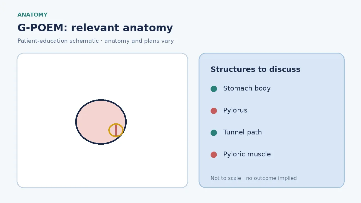 Medical illustration of the stomach and a narrowed pylorus delaying emptying