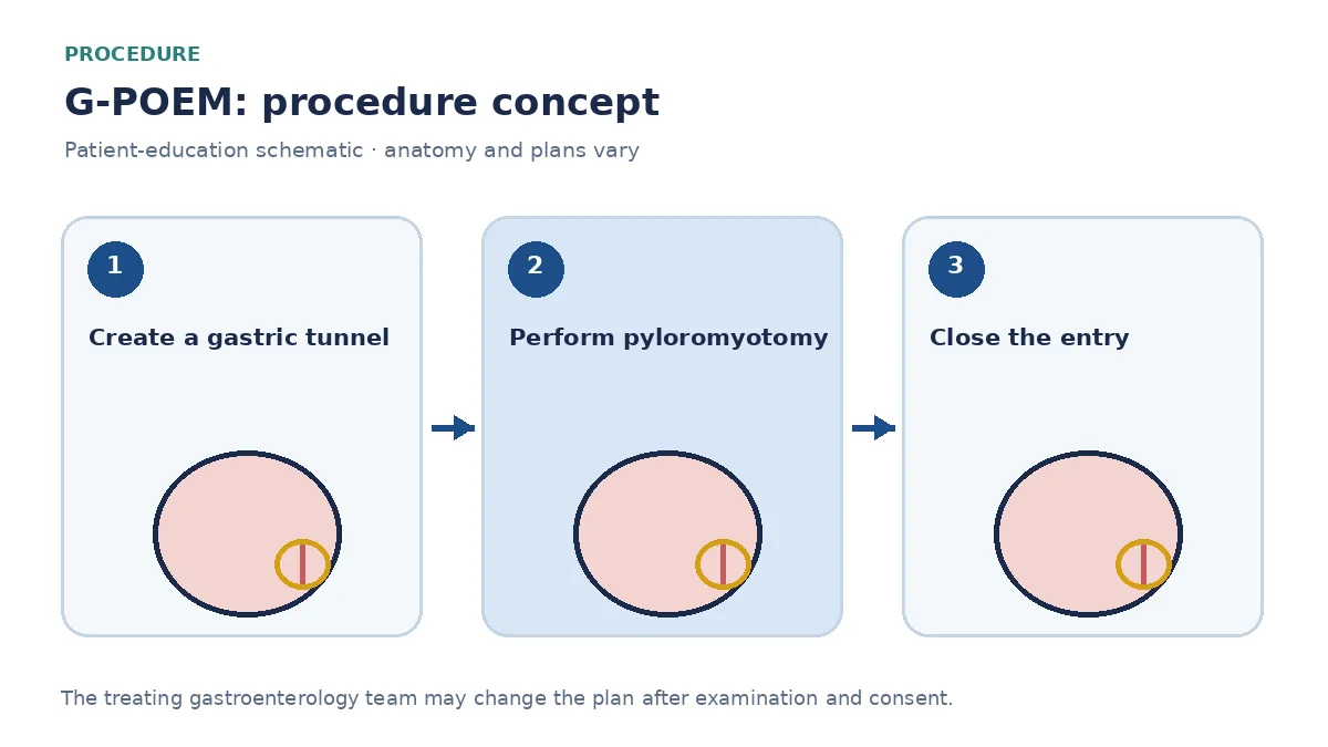 Clinical diagram of an endoscopic pyloric myotomy performed through a gastric tunnel during G-POEM