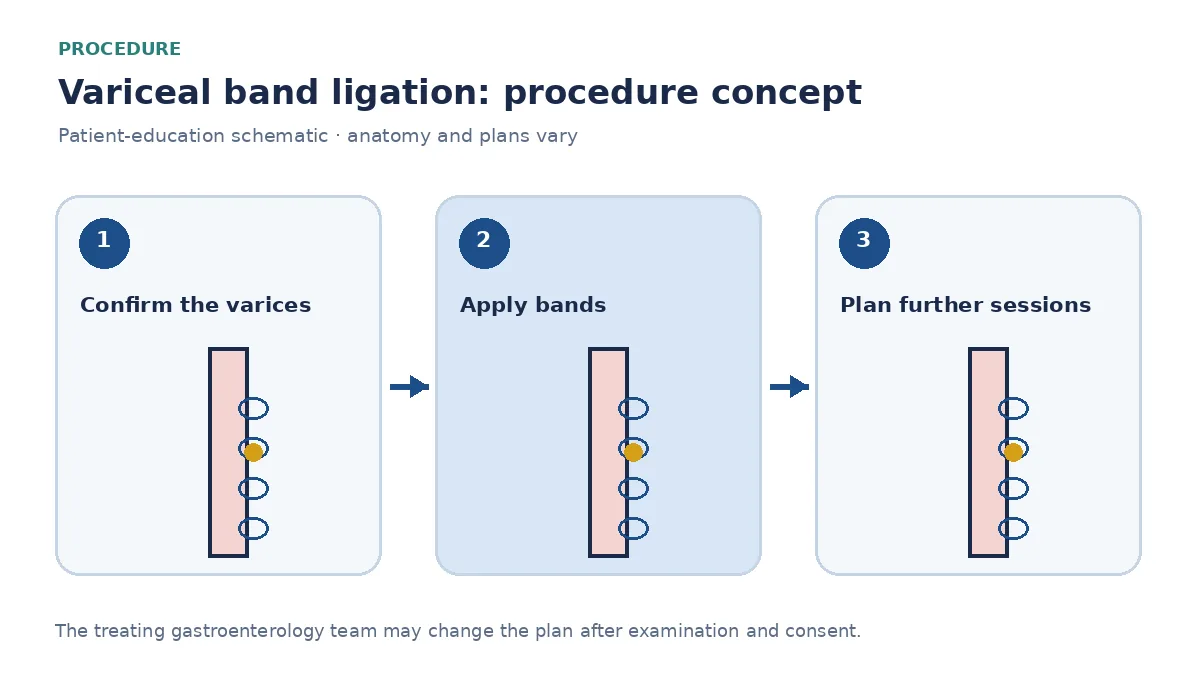 Clinical diagram of elastic bands placed on oesophageal variceal columns during ligation