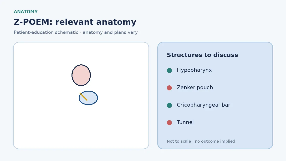 Medical illustration of a Zenker diverticulum pouch behind the cricopharyngeal bar