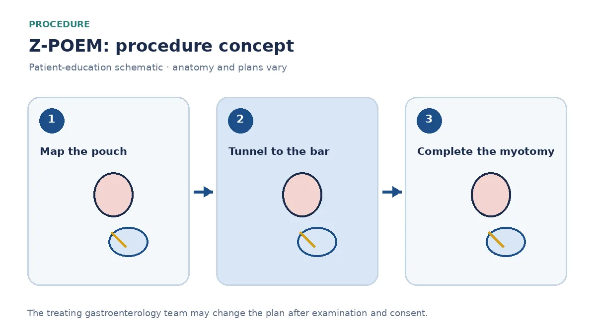 Clinical diagram of a submucosal tunnel approaching the Zenker septum during Z-POEM