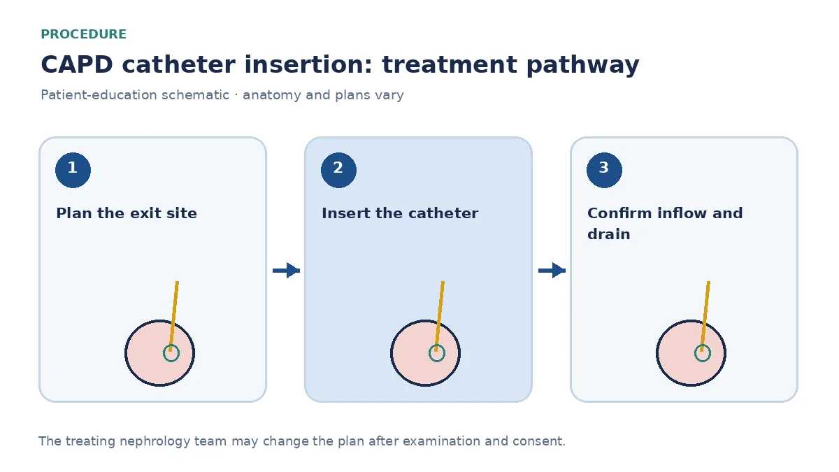 Step-by-step CAPD-catheter pathway showing abdominal assessment, insertion and a flush check