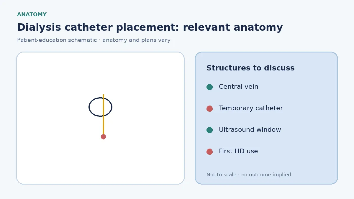 Medical infographic of a temporary dialysis catheter entering a central vein for hemodialysis access