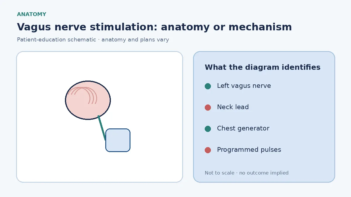 Patient-education diagram showing a chest pulse generator connected to a lead around the left cervical vagus nerve