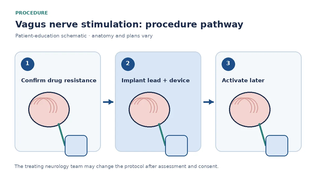 Numbered VNS pathway showing epilepsy review, lead and generator implantation, and later activation