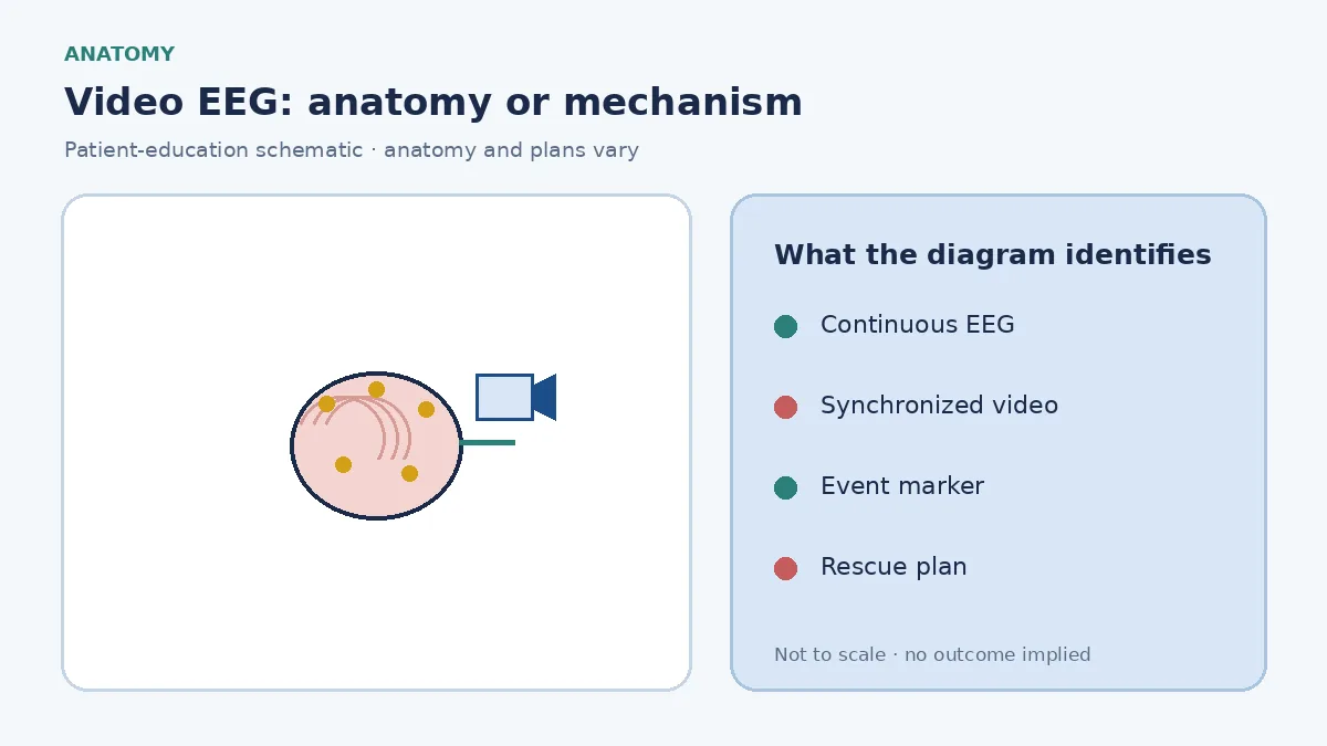 Patient-education diagram showing synchronized scalp EEG channels, bedside video and captured seizure behaviour