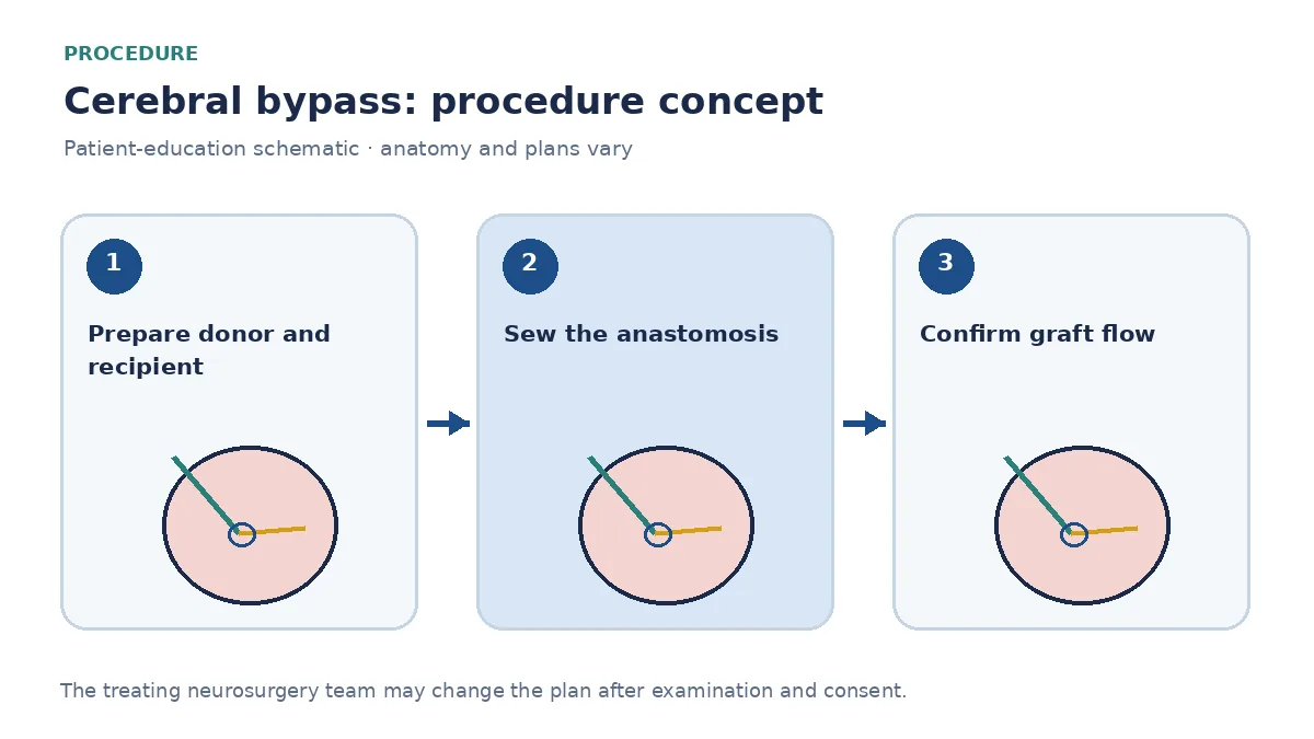 Clinical diagram of STA-MCA cerebral bypass anastomosis on the brain surface