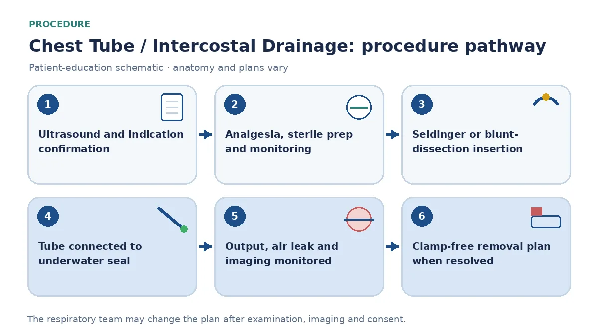 Chest-drain pathway showing ultrasound and indication confirmation, analgesia and sterile preparation, Seldinger or blunt-dissection insertion, seal connection, output and air-leak monitoring and removal planning