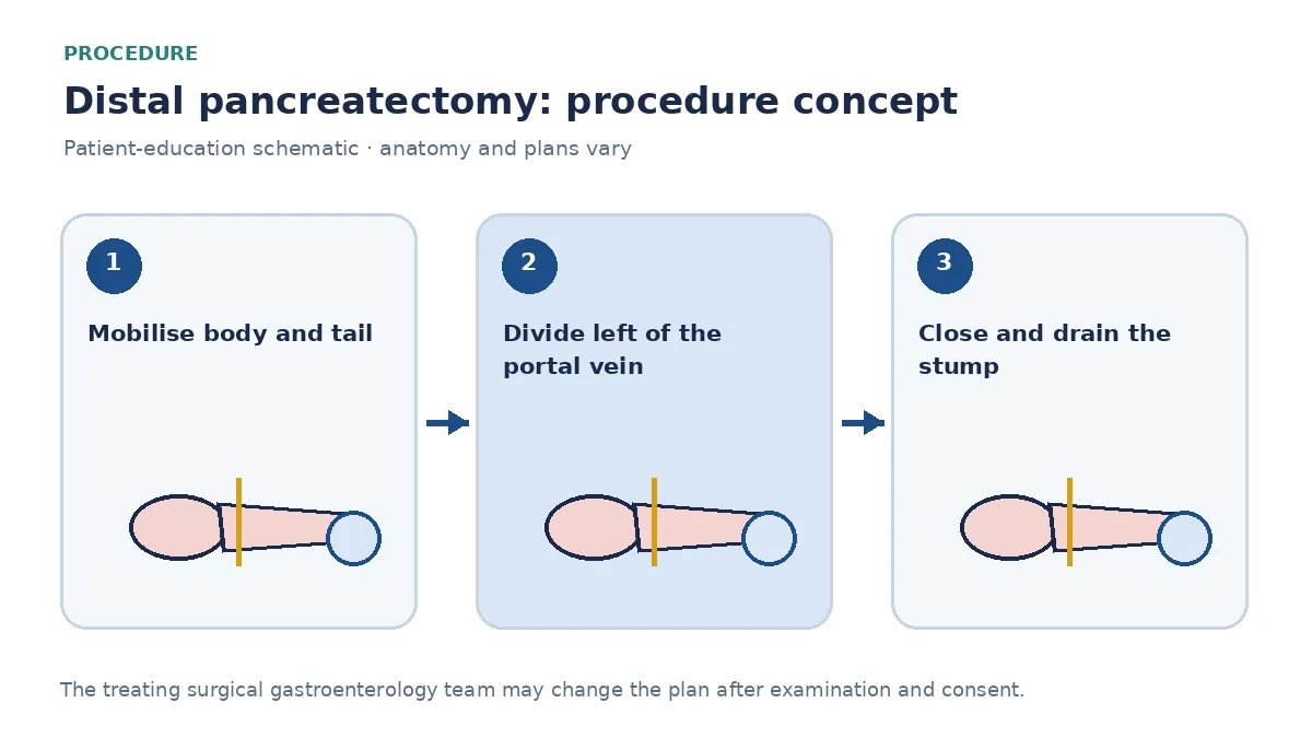 Clinical diagram of distal pancreatectomy showing division of the pancreas and optional splenectomy