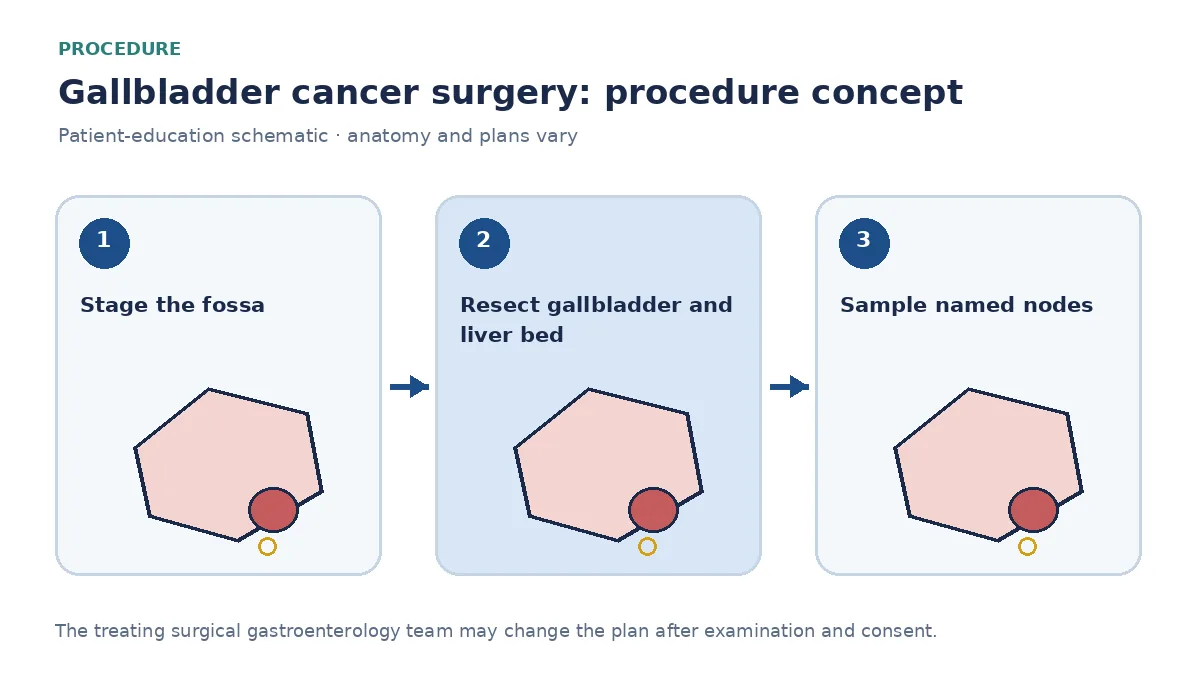Clinical diagram of radical cholecystectomy with liver-bed resection and regional node sampling