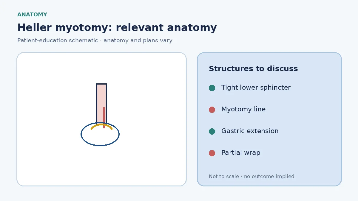 Medical illustration of a tight lower-oesophageal sphincter in achalasia with the planned Heller myotomy line