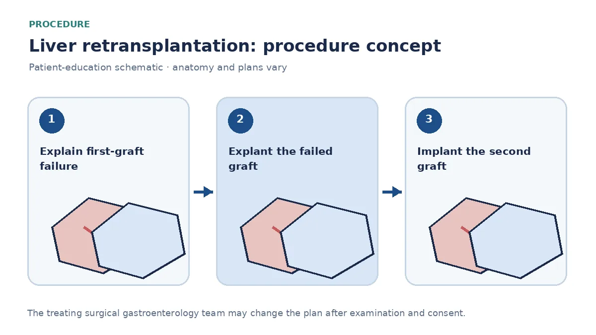 Clinical diagram of explanting a failed liver graft and implanting a second graft with vascular reconstruction
