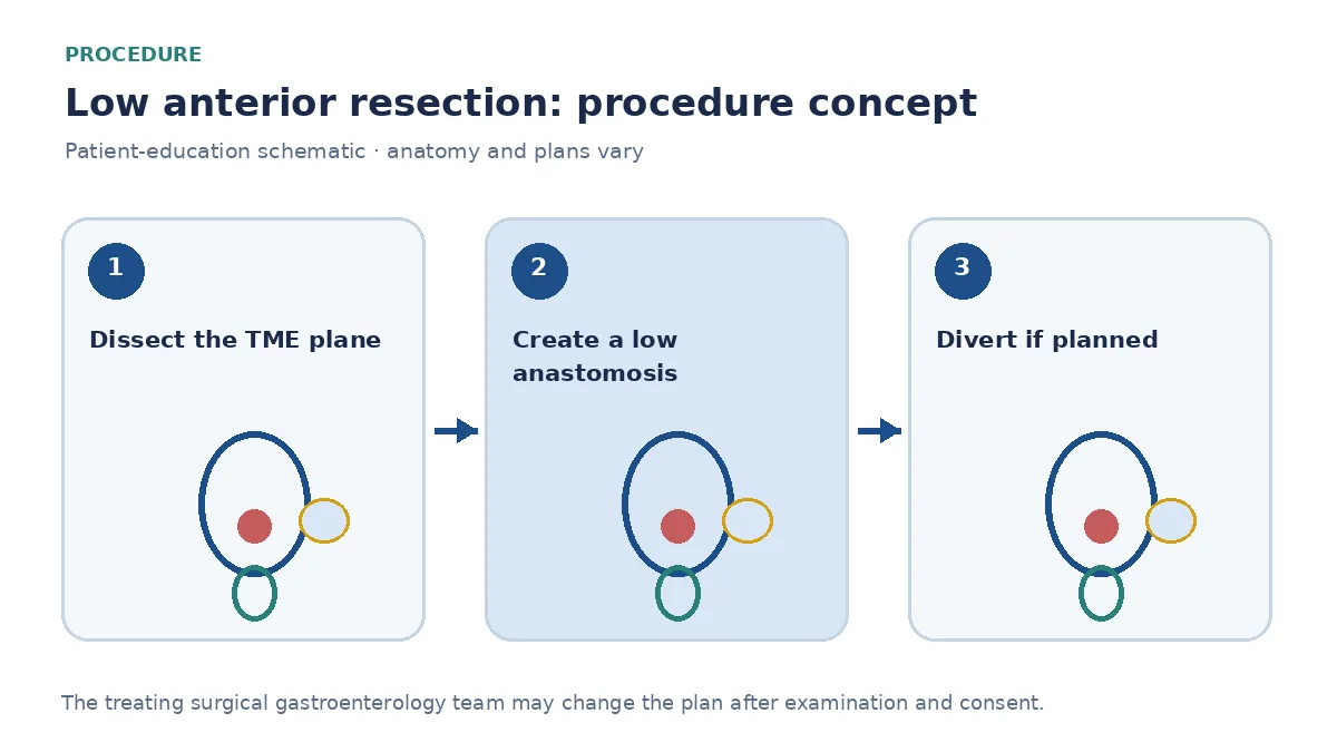 Clinical diagram of rectal resection, stapled anastomosis and optional diverting ileostomy