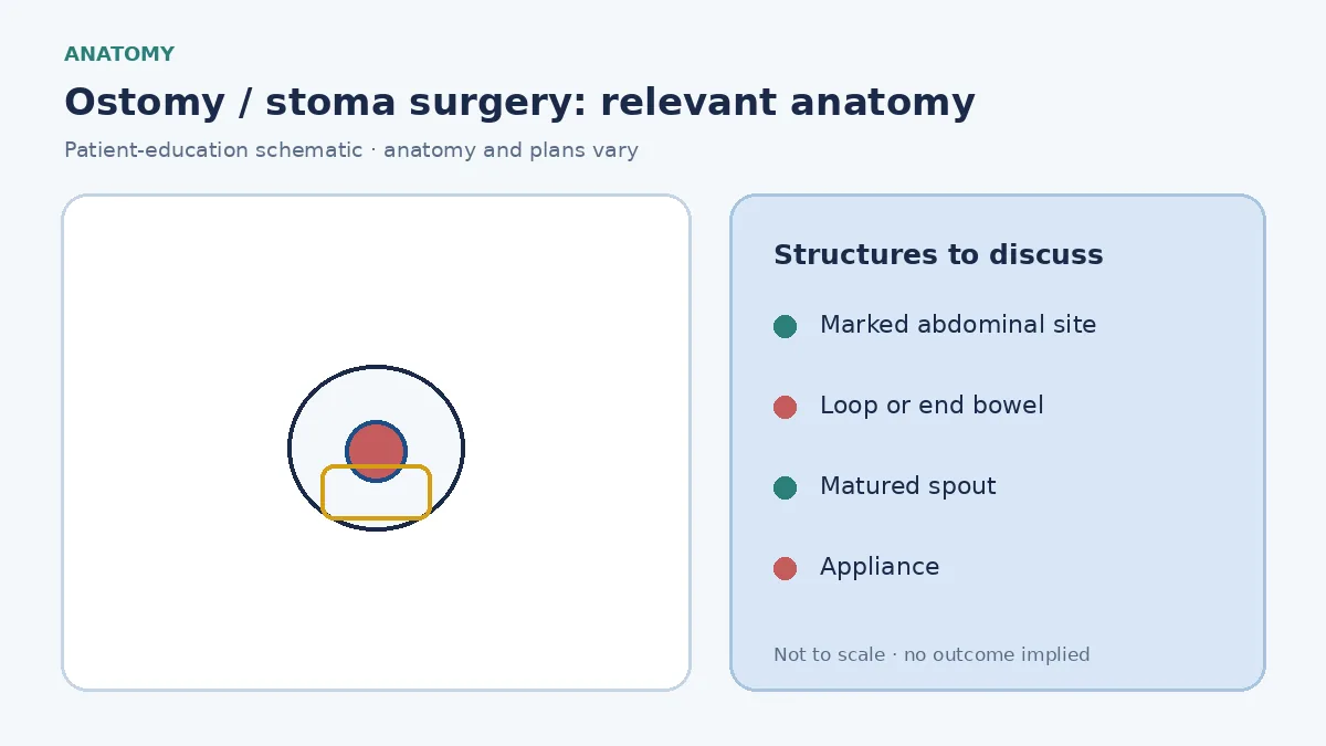 Medical illustration of ileostomy and colostomy sites on the abdominal wall with bowel brought through the rectus