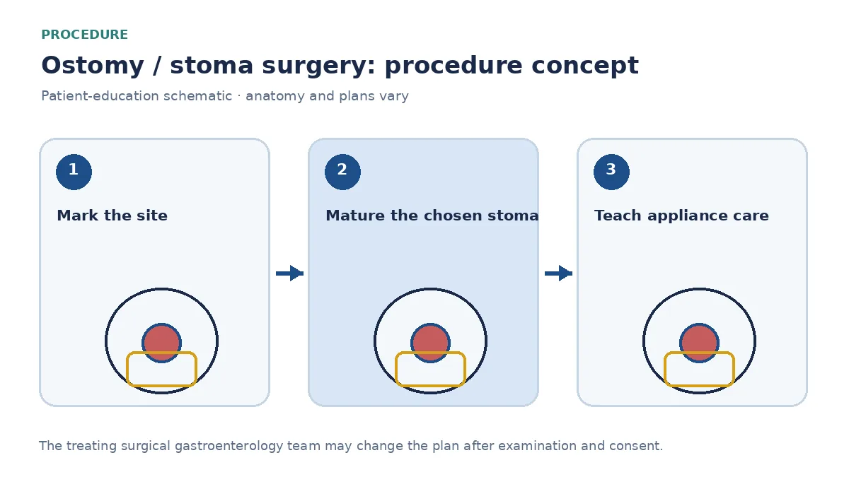 Clinical diagram of loop versus end stoma maturation and appliance placement
