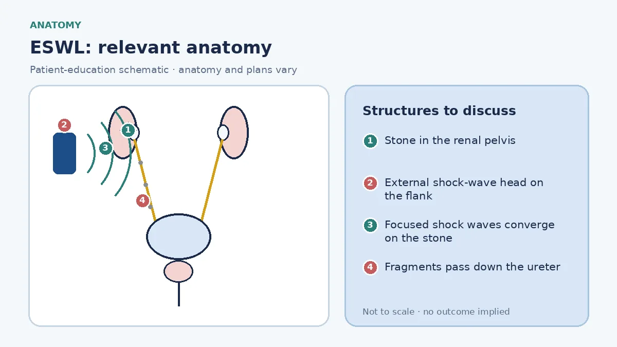 Medical infographic of ESWL anatomy showing a kidney with a stone in the renal pelvis and focused shock waves from an external lithotripter head converging on the stone through the flank