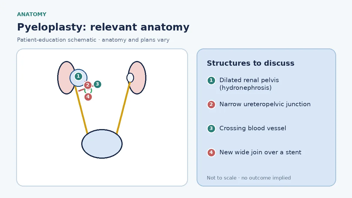 Medical infographic of pyeloplasty anatomy showing a kidney with a dilated renal pelvis narrowing at the ureteropelvic junction, a crossing vessel and the normal ureter below