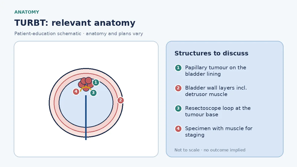 Medical infographic of TURBT anatomy showing a bladder in cross-section with a papillary tumour on the lining, the layers of the bladder wall including the detrusor muscle and a resectoscope loop at the tumour base
