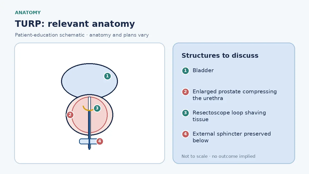 Medical infographic of TURP anatomy showing the bladder, an enlarged prostate compressing the urethra, the external sphincter below and a resectoscope loop removing the inner obstructing tissue