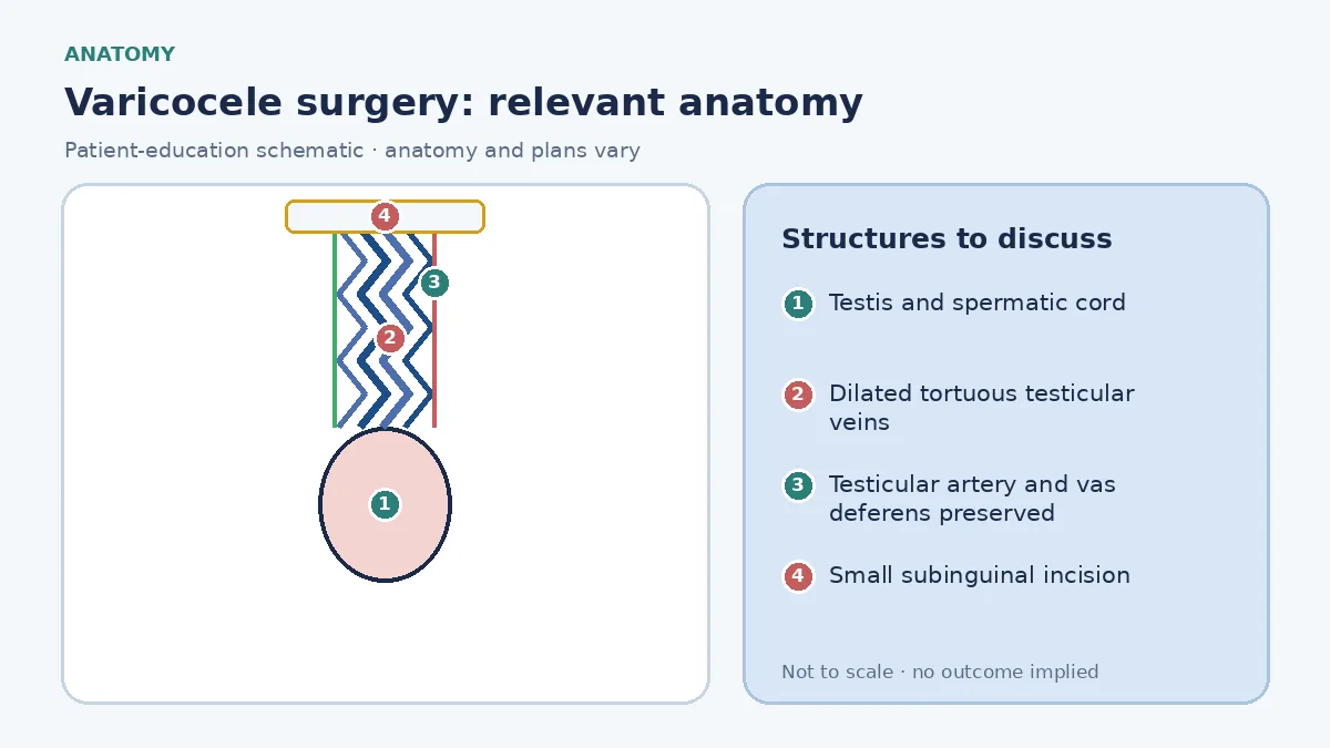 Medical infographic of varicocele anatomy showing the testis and spermatic cord with dilated, tortuous testicular veins on the left side compared with normal veins on the right and the preserved testicular artery and vas deferens
