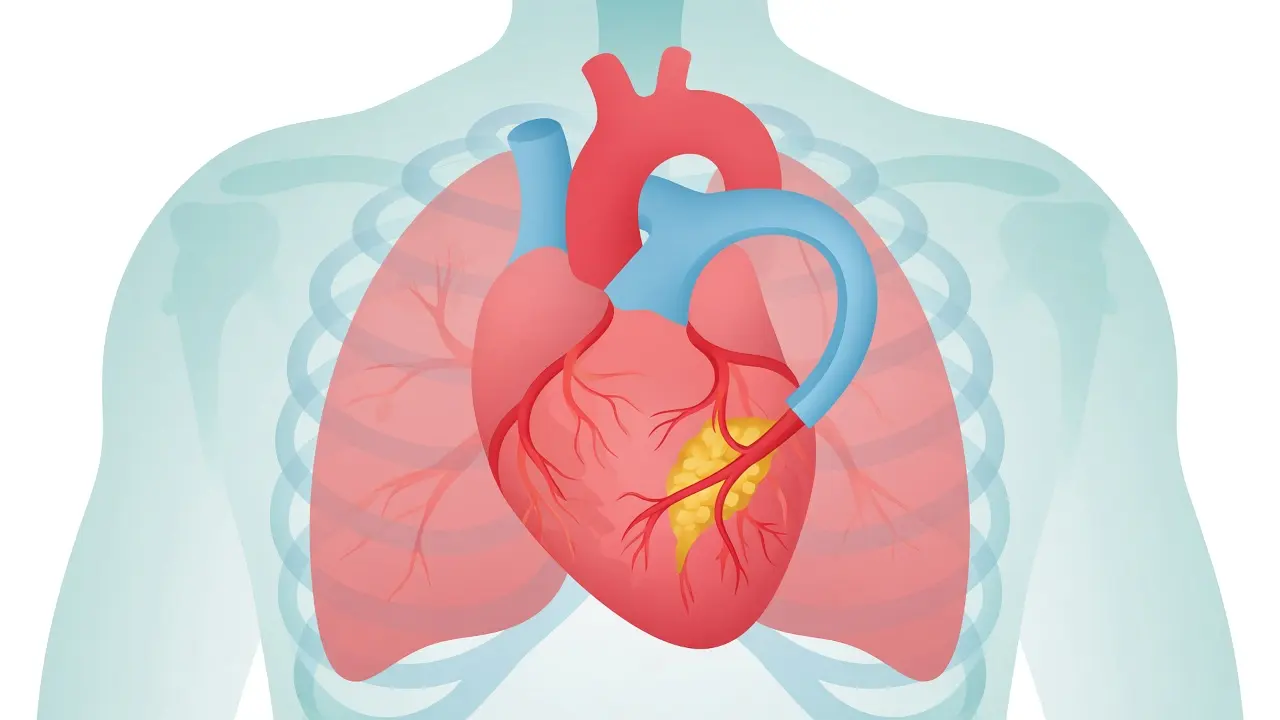 A graft tube from the aorta past a yellow blockage on a coronary artery