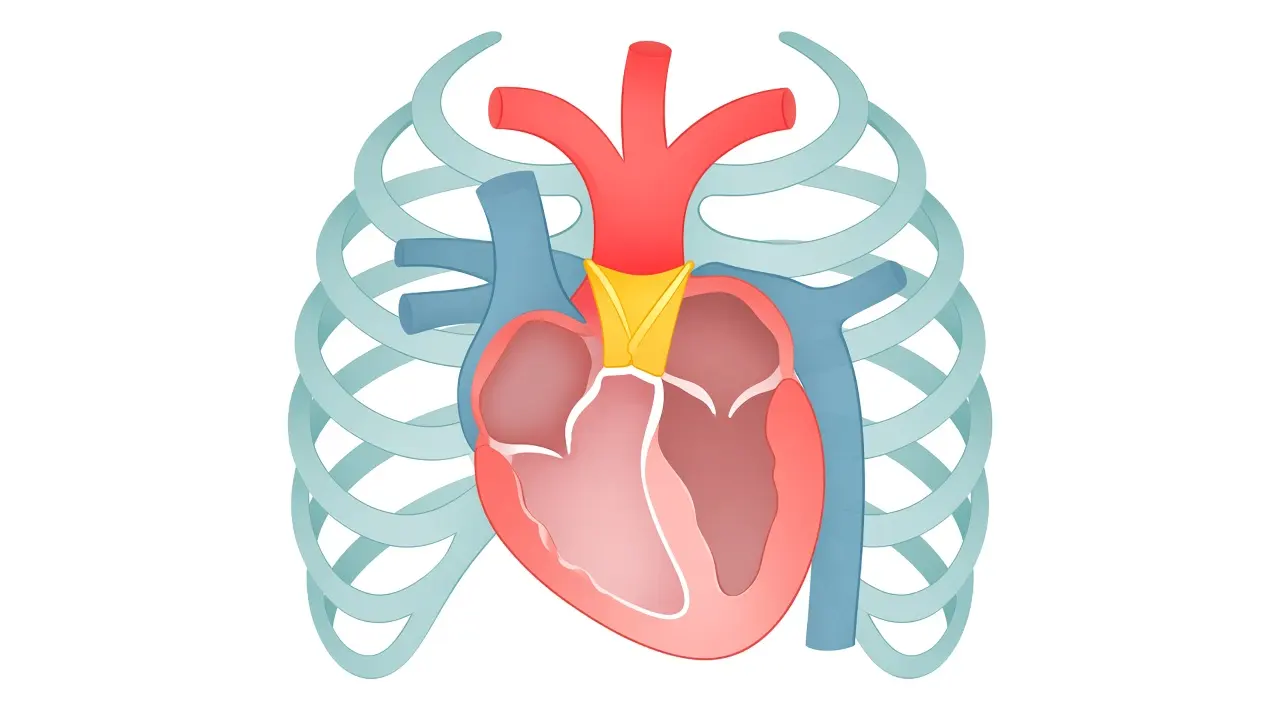 Thick yellow valve leaflets where the aorta leaves the top of the heart