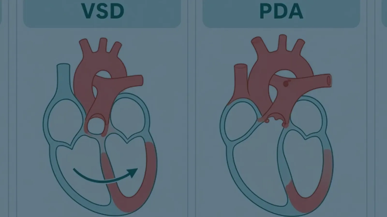 Educational illustration of ASD, VSD, PDA and tetralogy of Fallot schematics